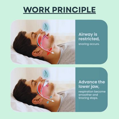 The Silent Anti-Snoring Mouthpiece